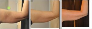 Tratament grasime/ piele flasca brate- VelaShape III- 5 sedinte