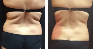 Tratament grasime spate-aripioare VelaShape III- 4 sedinte