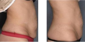 Tratament grasime si piele lasata abdomen- VelaShape III- 6 sedinte