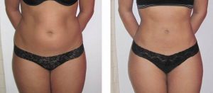 Tratament grasime abdomen- VelaShape III- 6 sedinte