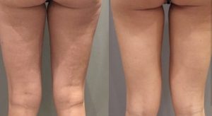 Tratament anticelulitic VelaShape III - 4 sedinte