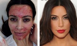 Ce presupune terapia vampir sau tehnica PRP?